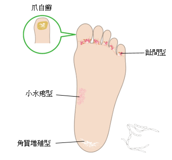 足の水虫の種類