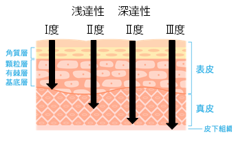 やけど_浅達性_深達性